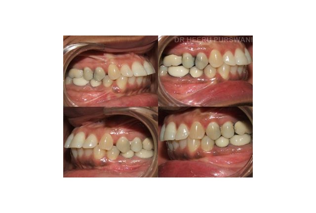 Aligners 