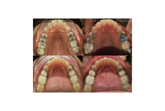 Aligners 