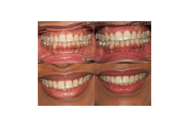 Aligners