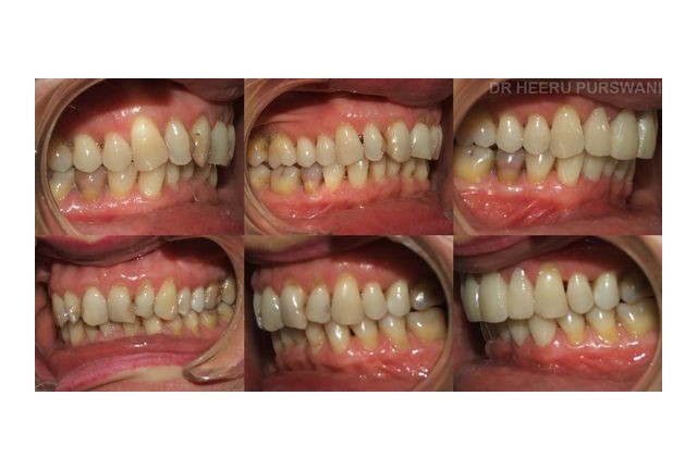 Aligners-after restorative work