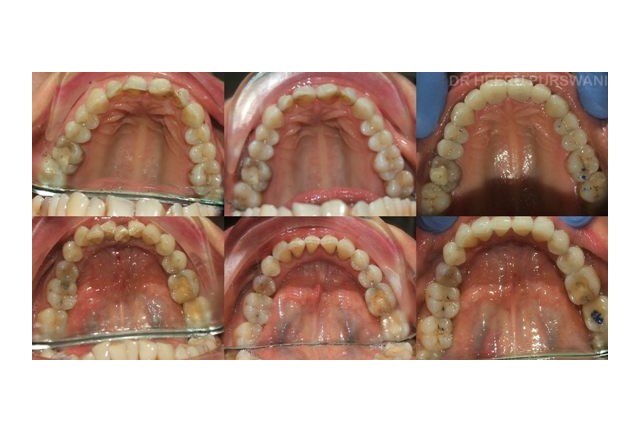 Aligners-after restorative work 