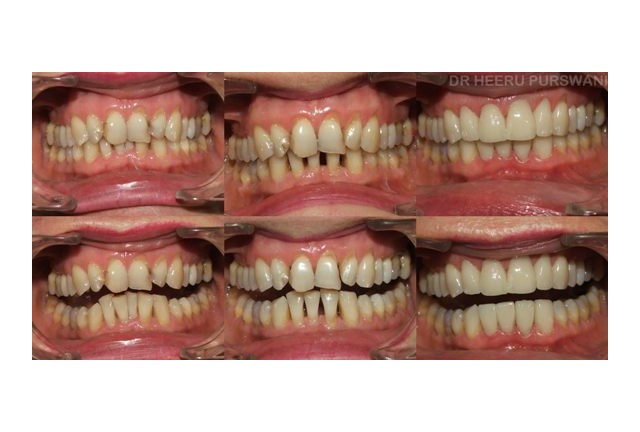Aligners-after restorative work