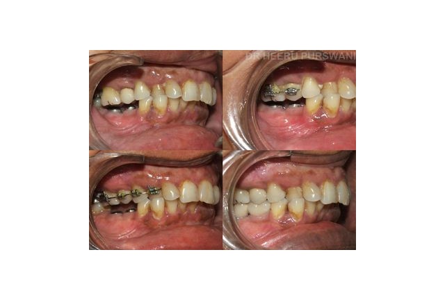 Creating space for lower replacement by upper teeth intrusion