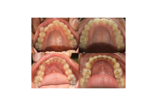 crossbite 