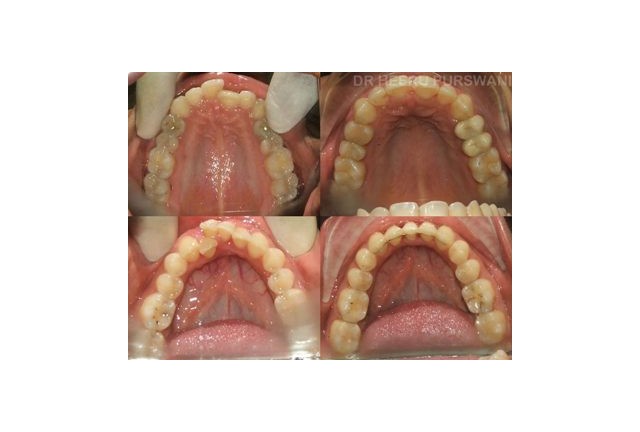 crossbite 