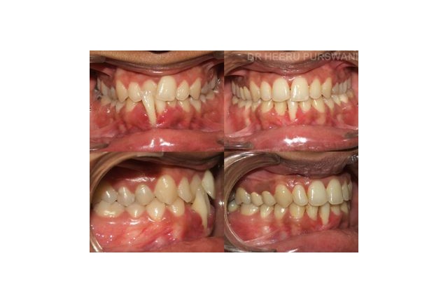 crossbite