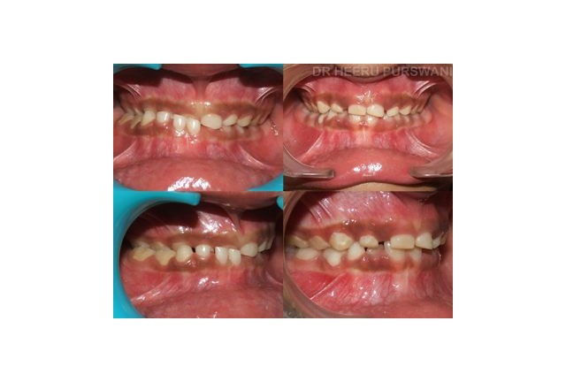 Crossbite in the milk teeth