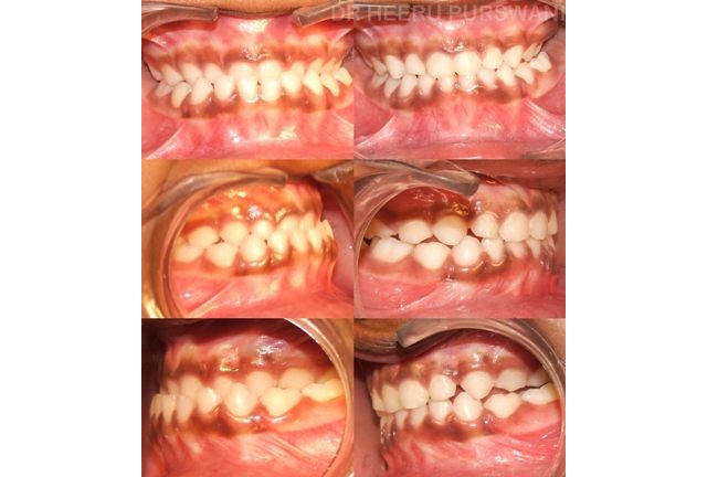 Crossbite in the milk teeth 