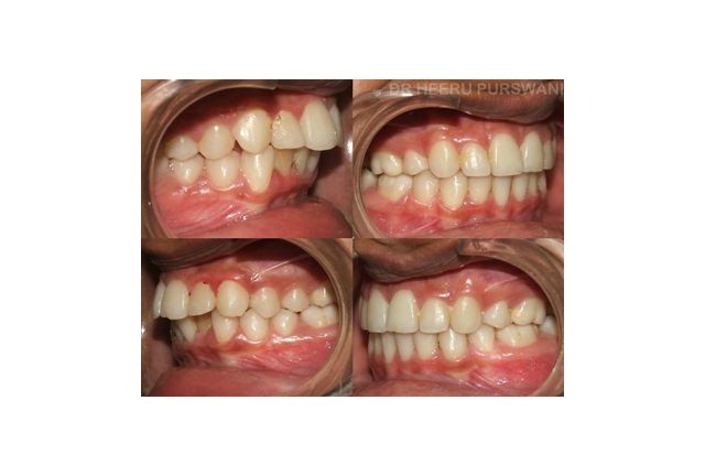 crowded teeth 