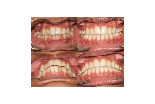 crowded teeth 