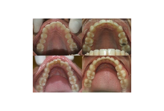 crowded teeth