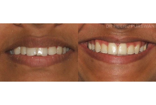 crowded teeth