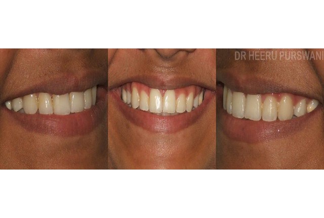 crowded teeth