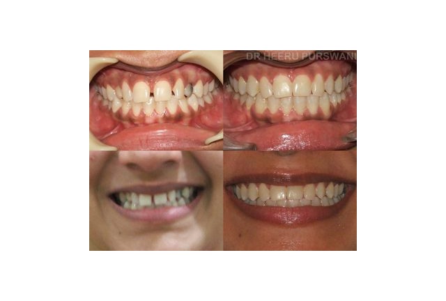 Impacted upper canines 