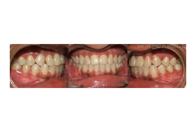 Impacted upper canines 
