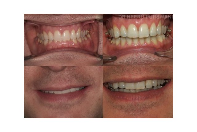 Lingual  braces 