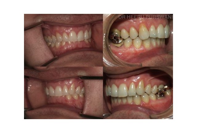 Lingual  braces 