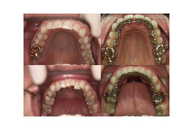 Lingual  braces 