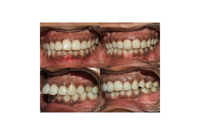 Lingual Braces 