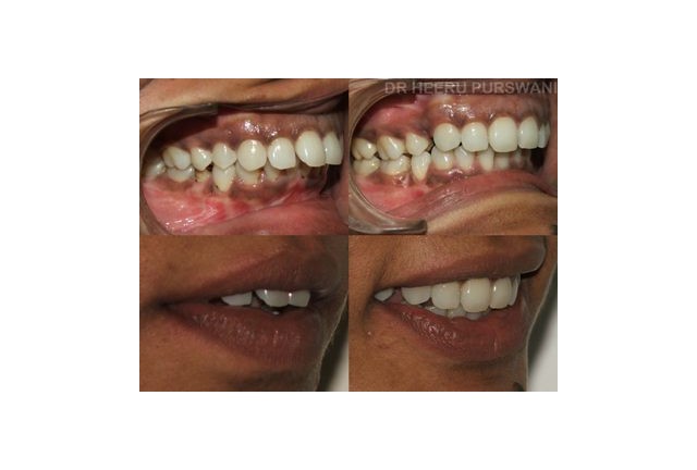 Lingual Braces
