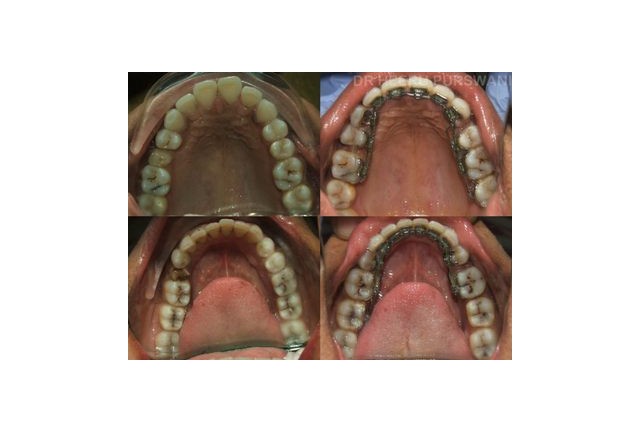 Lingual Braces 