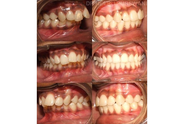 Proclined and irregular teeth 