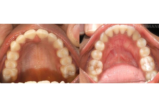 proclined and irregular teeth 
