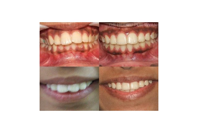 proclined teeth 