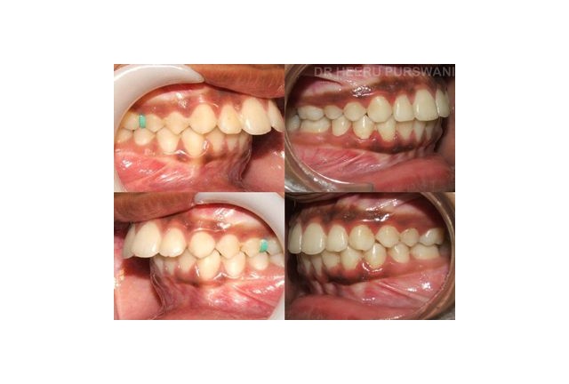 proclined teeth