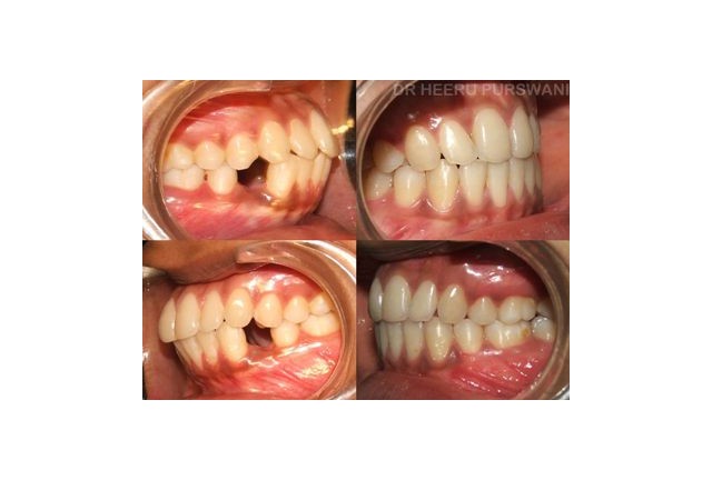 Proclined teeth 