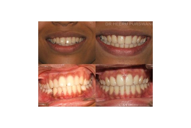 Proclined teeth 